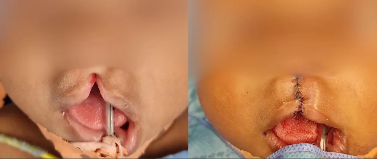 Fente labiale avant et juste après l’intervention de chirurgie réparatrice