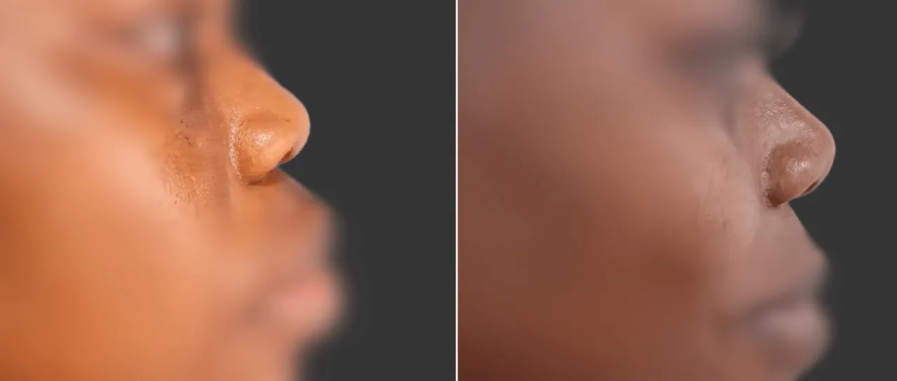 Nez de profil avant et après une rhinoplastie ethnique